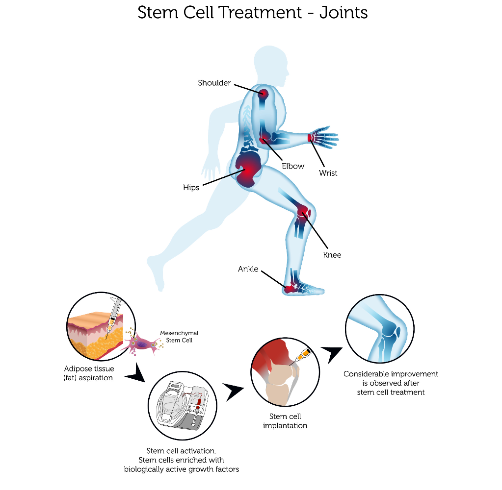Athlete receiving joint MCT